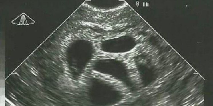 Liječnici su joj savjetovali pobačaj &ndash; 20 godina kasnije objavila je ove slike