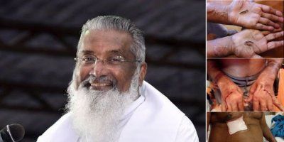 FOTO Otac James Manjackal na svome tijelu nosi &bdquo;Rane Isusove&ldquo;! Njegov liječnik svjedoči o čudima i hrabrosti jednog od najvećih evangelizatora na svijetu