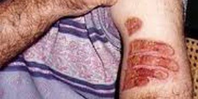 ČUDO Dobio opeklinu na ruci u obliku ruke svetog Šarbela 